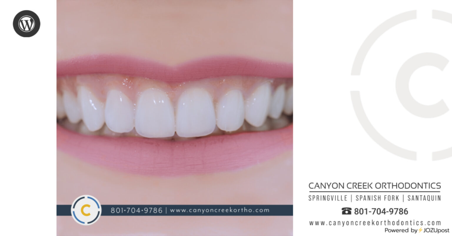 Straight Teeth Are No Accident Spanish Fork Orthodontist Canyon